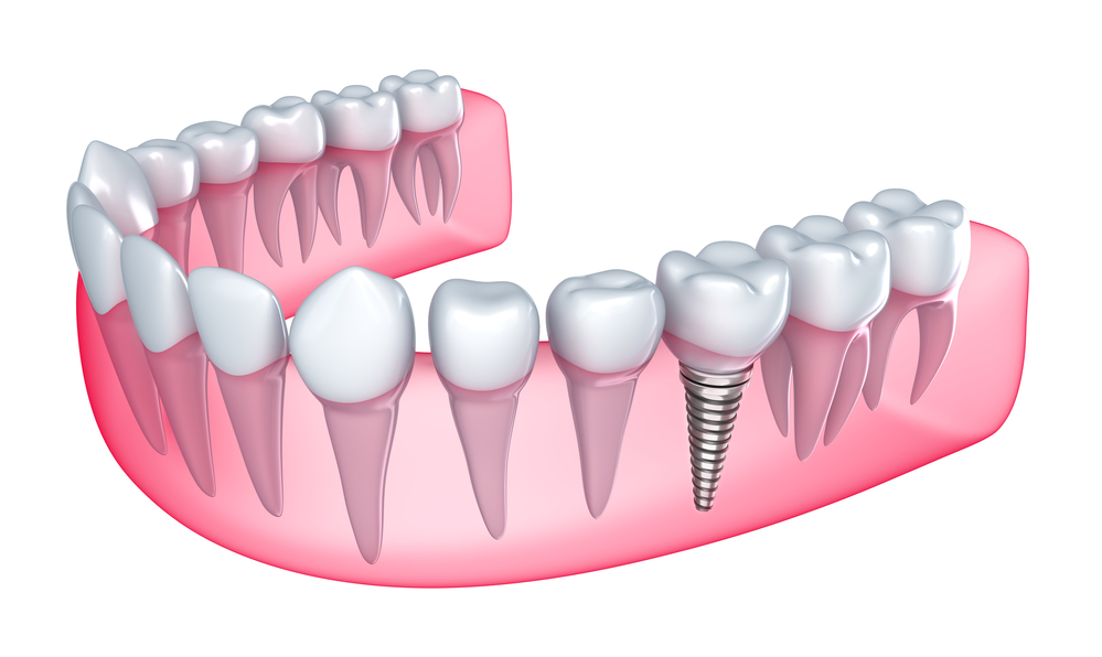 implantes dentales y regeneración ósea